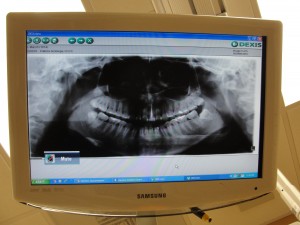 180 degree x-ray scan of my teeth