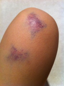 bruising on knee and thigh area turned purple