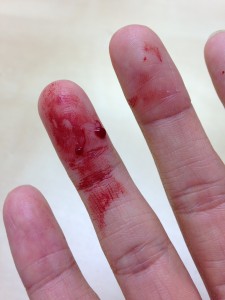 bloody fingers cut in multiple places