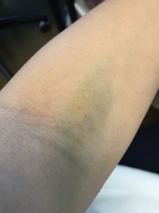 bruised crook of arm from needle poke
